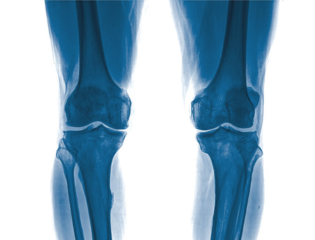 X-ray of Kneeの写真素材