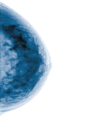 Mammogram radio imaging for breast cancer diagnosisの写真素材