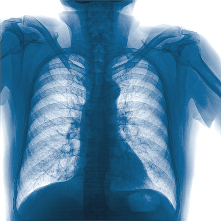 Detail of an x-ray of lungs on black backgroundの写真素材