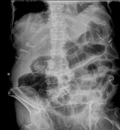 picture of intestinal abdominal xrayの写真素材