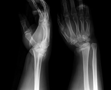 X-ray photos of hand bone fracture patientsの写真素材