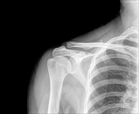 X-ray of shoulder joint / Many others X-ray images in my portfolio.の写真素材