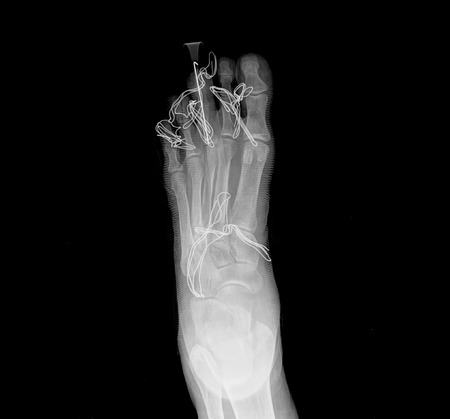 x-ray of footの写真素材