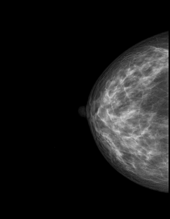 X-ray mammogram image of breast with cancerの写真素材
