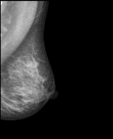X-ray mammogram image of breast with cancerの写真素材