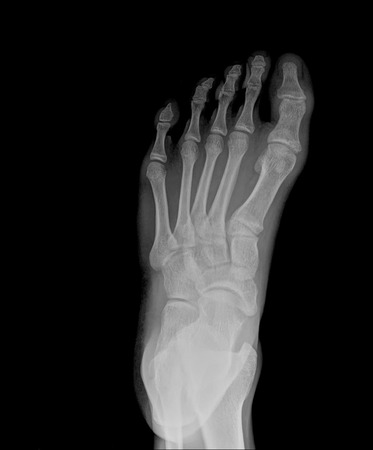 x-ray of footの写真素材