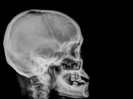 skull x-rays image sagital planeの写真素材