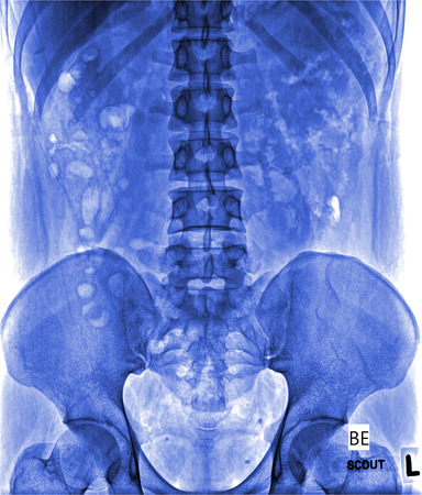X-ray lumbo-sacral spine and pelvisの写真素材