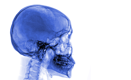 skull x-rays image sagital planeの写真素材