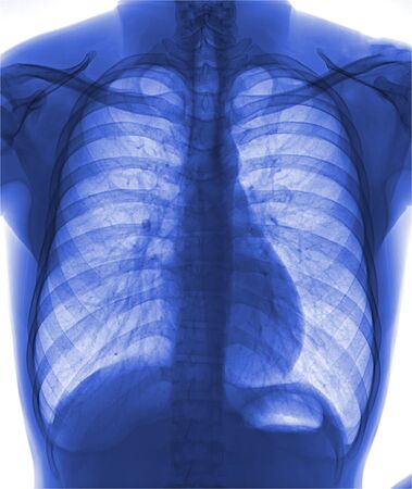 View of a human x-ray film, taken to examine the lungsの写真素材