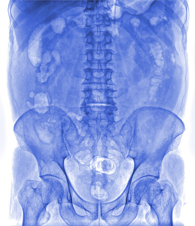 X-ray lumbo-sacral spine and pelvisの写真素材