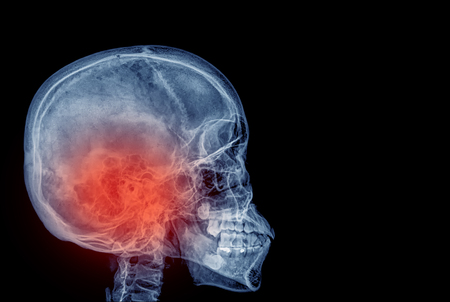 skull x-rays image sagital planeの写真素材