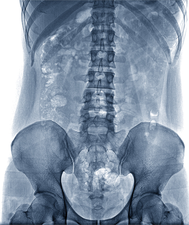 X-Ray Image the spine fornt view Of Human for a medical diagnosis , isolate on white backgroundの写真素材