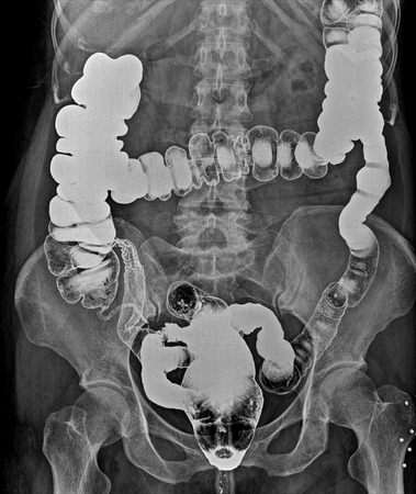 X-ray image of plain abdomen , colonの写真素材