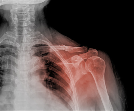 X-ray of human shoulderの写真素材