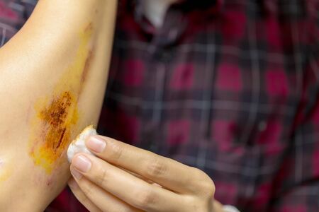 Young Man With Bloody Scrape on Armの写真素材