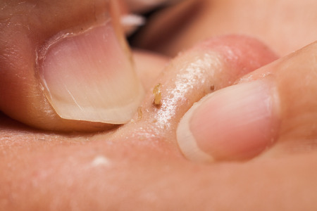 Squeezing pimple blackheads from the nose of a teenagerの写真素材