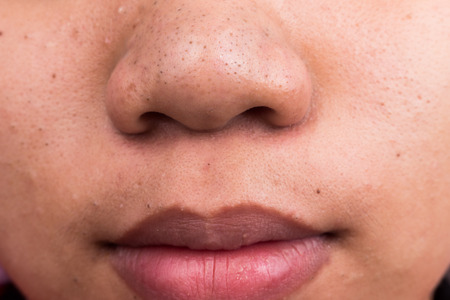 Pimple blackheads on the nose and lips of a teenagerの写真素材