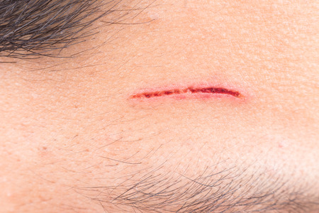 Deep painful cut on the foreheadの写真素材