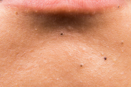 Close up on ugly acne pimples zit blackheads on the jaw of a teenagerの写真素材