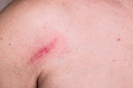 Minor but painful bruise on skin between shoulder and chestの写真素材