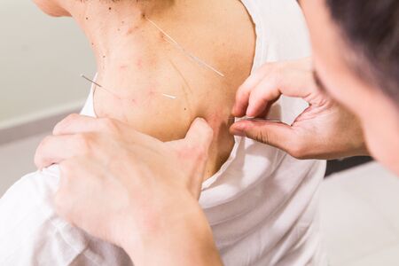 Selective focus of acupuncturist pricking needle into skin, with shallow depth of field.の写真素材