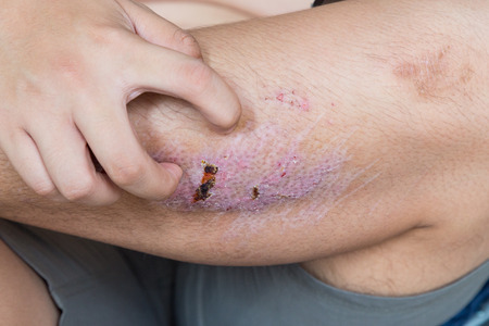 Finger scratching itchy scar knee with healing injury from abrasion