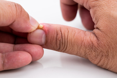 Series of close-up painful finger nail skin infection with pus and treatment