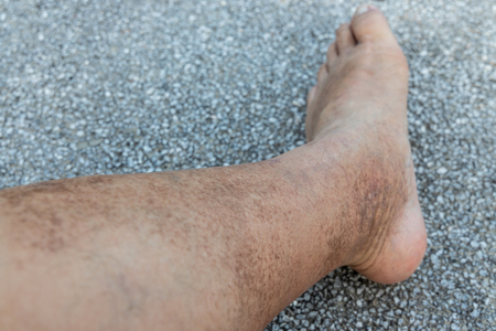 Skin pigmentation on neglected leg of matured male Asian.  Needs treatment.の写真素材