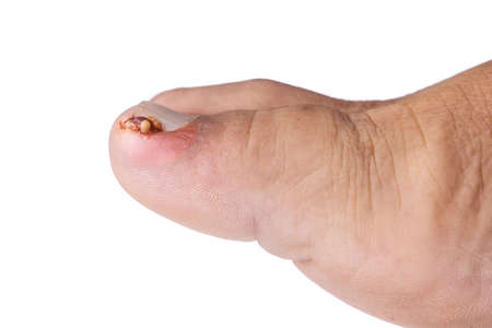Closeup of inflammation and blood associated with painful ingrown toenailの写真素材