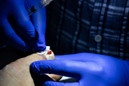 Series of ingrown toenail treatment. Medical doctor cleaning wound before surgery on toenail.の写真素材