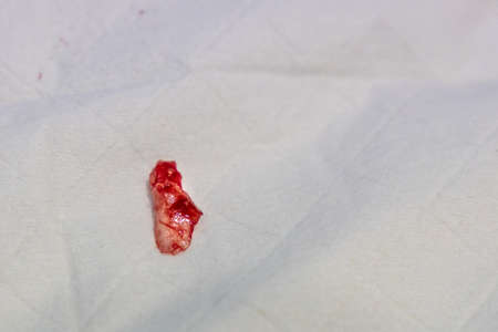 Closeup of extracted ingrown toenail on piece of gauz in hospital