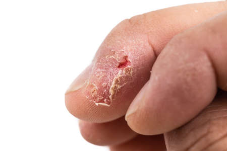 Closeup of painful inflammed damaged dry skin on the finger