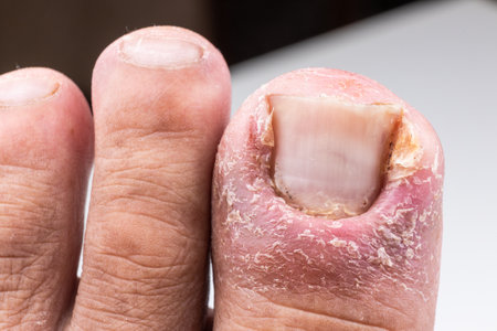 Closeup of painful inflammed infection of the big toe due to ingrown toenailの写真素材