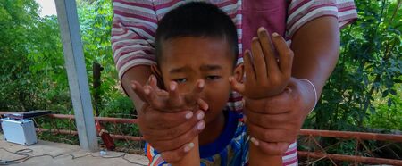The boy have hand six finger are stand up for photographers take pictures at the village in the countryside of Thailand.Mahasarakham,Thailand,October 2015のeditorial素材
