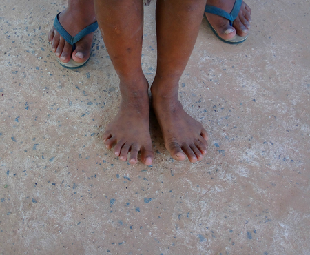 The boy have hand six finger and six toes are sitting for photographers take pictures at the village in the countryside.Mahasarakham,Thailand,October 2015のeditorial素材