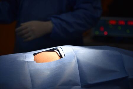 Team surgeon at work in operating room. Surgical light in the operating room. Preparation for the beginning of surgical operation with a cut. The surgeon is performing surgery on the patient.の写真素材
