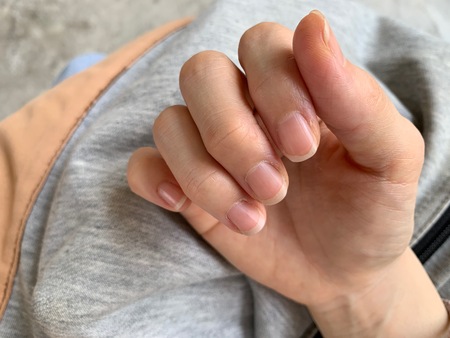 The fingers of the woman are dry The nail edge is flaky, Should be applied to the cream, Dry skin...
