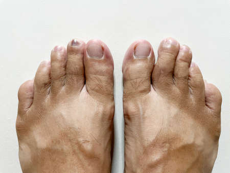 Injury, purple toenails caused by wearing shoes for a long time, wearing running shoes that are too small can cause purple toenails.の写真素材