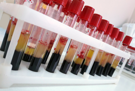 Tubes of blood sample for lab testing
