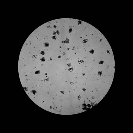 View of the Uric acid in the urine sediment through a microscope. Causes kidney stonesの写真素材