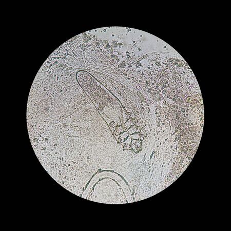 Demodex mite from a microscope view. The parasite causing a skin disease -Demodecosis
