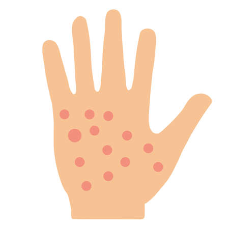eczema hand skin icon on white background. allergic reaction symbol. irritation on hand sign. flat style.のイラスト素材