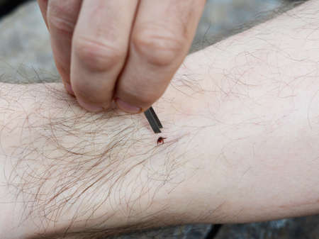 Removing a blacklegged tick using fine pointed tweezers. Matchless way of tick removal.の写真素材