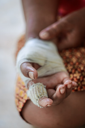 Hand of old woman injured and bandaged.の写真素材