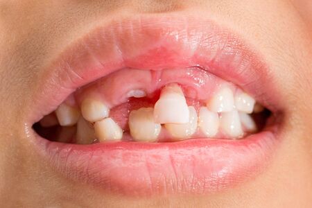 Milk teeth that are about to fallの写真素材