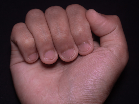 photo of reddish brown hand nails cut by teeth with black isolated background.の写真素材