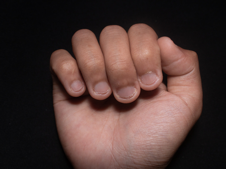 photo of reddish brown hand nails cut by teeth with black isolated background.の写真素材