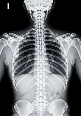 X-Ray image of human chest with visible vertebrae.