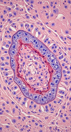 Histopathology of breast cancer, light micrograph, photo under microscopeの写真素材